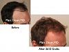 Click image for larger version

Name:	Hair Transplant Slides5.039.jpg

Size:	56.9 KB
ID:	23659