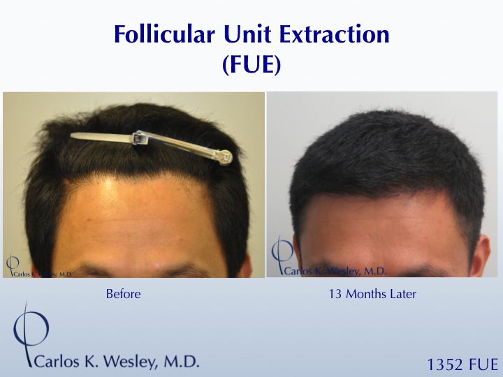 1352 FUE grafts to frontal region