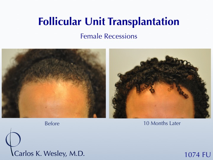 An interactive video montage of this patient may be viewed here:  
 
https://vimeo.com/39201138 
 
An interactive before/after image of this female...