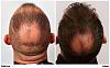 Click image for larger version

Name:	patient-mil-before-after-back-dry.jpg

Size:	85.1 KB
ID:	57811