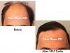 Click image for larger version

Name:	Hair Transplant Slides.554.jpg

Size:	60.5 KB
ID:	38659