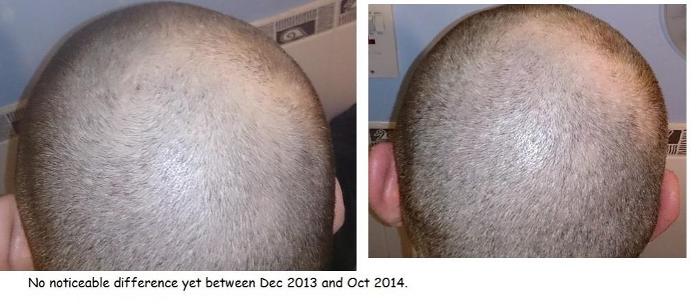 Click image for larger version

Name:	3 Hair loss Progress #1.jpg

Size:	69.0 KB
ID:	36891