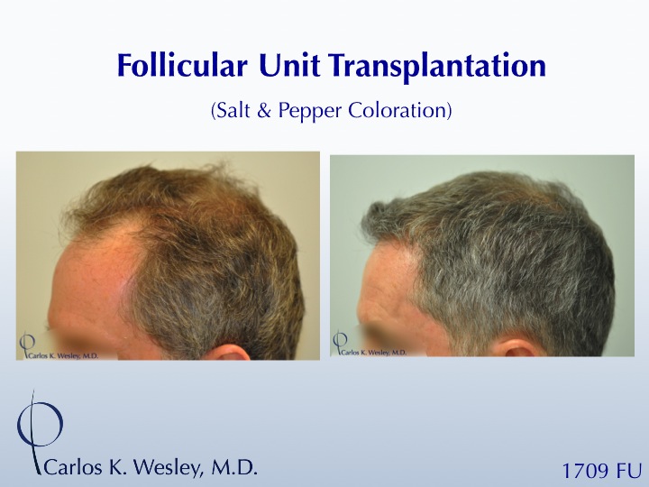 A video montage of this patient's transformation may be viewed here: 
 
https://vimeo.com/67214017