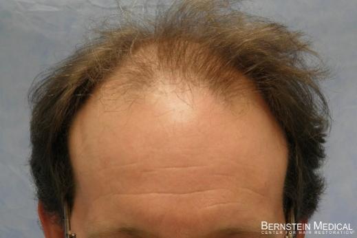 Click image for larger version

Name:	03_before-hair-transplant.jpg

Size:	19.9 KB
ID:	44108
