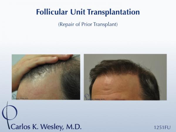 Before/After 1251 grafts 
Dr. Wesley repairs a hairline initially transplanted by a different surgeon. The patient's wide donor scar was also...