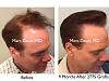 Click image for larger version

Name:	Hair Transplant Slides copy50.008.jpg

Size:	16.9 KB
ID:	46810