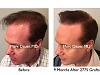 Click image for larger version

Name:	Hair Transplant Slides copy50.006.jpg

Size:	16.5 KB
ID:	46811