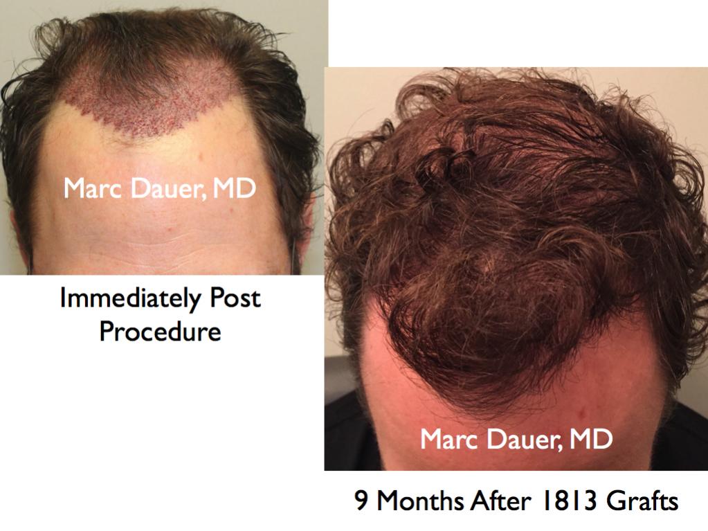 Click image for larger version

Name:	Hair Transplant Slides1.365.jpg

Size:	87.4 KB
ID:	36436