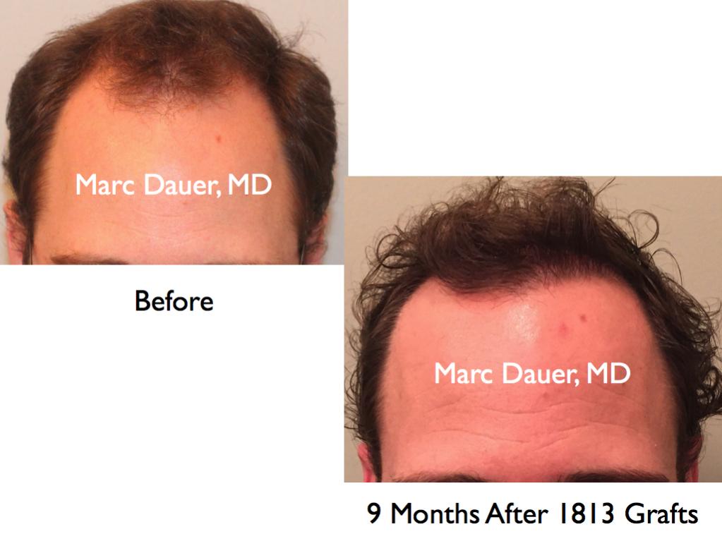 Click image for larger version

Name:	Hair Transplant Slides.362.jpg

Size:	61.1 KB
ID:	36437