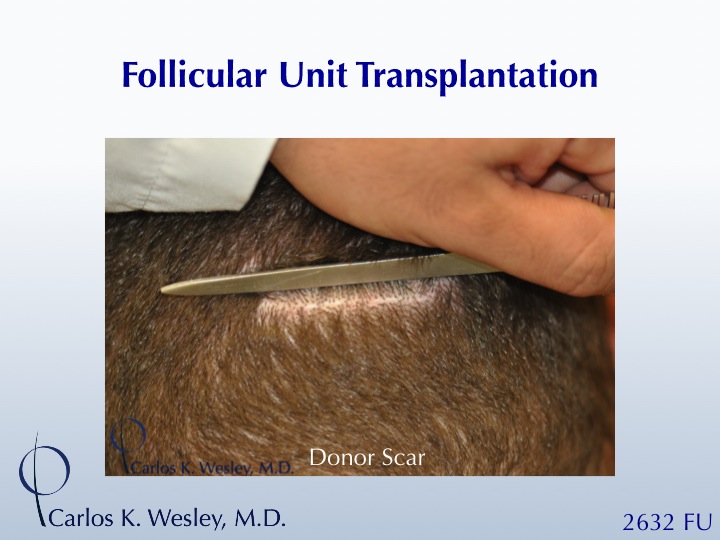 This patient presented to Dr. Carlos K. Wesley (NYC) for a hairline advancement.