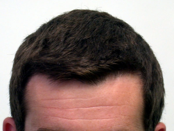 Click image for larger version

Name:	4.-Hairline-after.jpg

Size:	43.2 KB
ID:	974