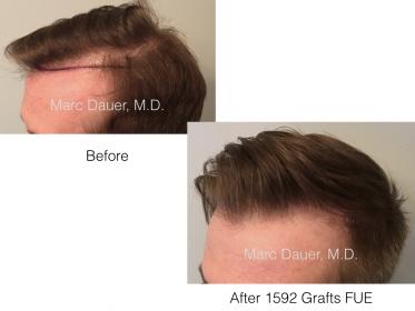 Dr. Marc Dauer hair transplant photos