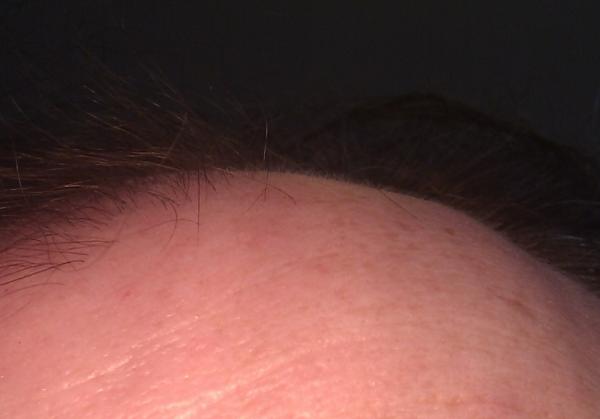 Hair peach fuzz growth - Day 5 TRX-2.