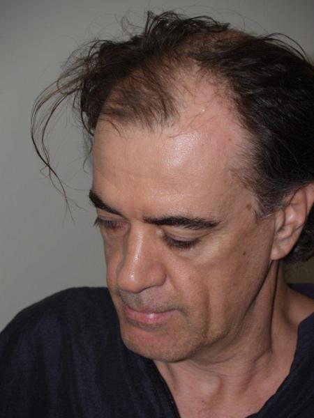 Before Hair Transplant Procedure