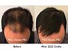 Click image for larger version

Name:	Hair Transplant Slides copy30.004.jpg

Size:	15.5 KB
ID:	45859