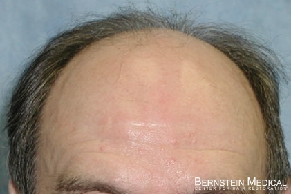 Click image for larger version

Name:	hairline-b.jpg

Size:	68.3 KB
ID:	26308