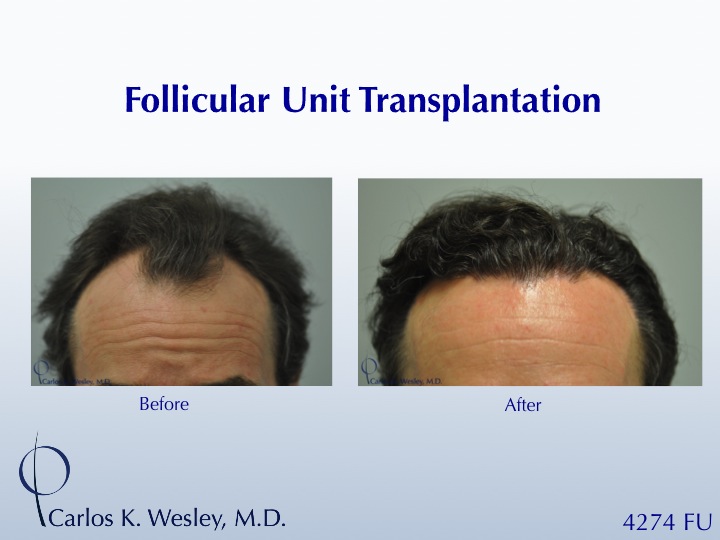 Before/After images of this 50-yr-old patient after a 4250-graft treatment by Dr. Carlos K. Wesley.  A video of his transformation may be viewed at...