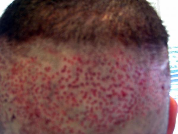 Day1 FUE Hair Transplant Dr Woods straight after donor was taken out - back head