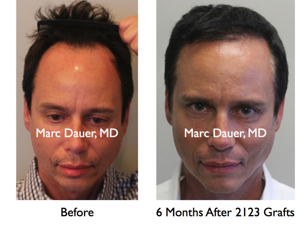 Click image for larger version

Name:	Hair Transplant Slides2.287.jpg

Size:	71.4 KB
ID:	35507