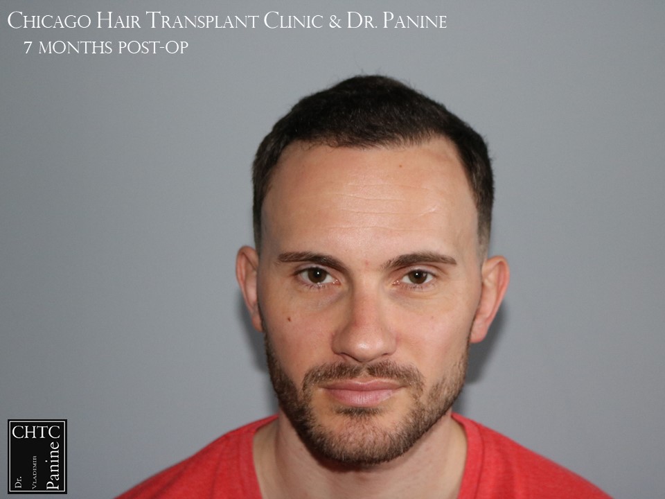 PANINE, MD FUE Hair Transplant Results