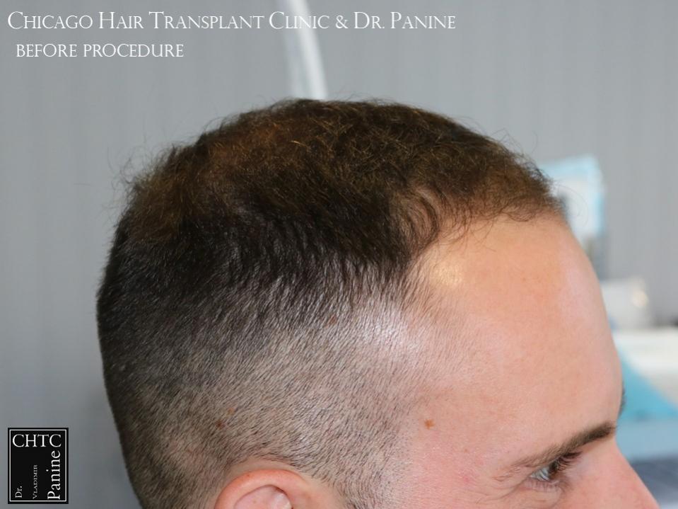 PANINE, MD FUE Hair Transplant Results