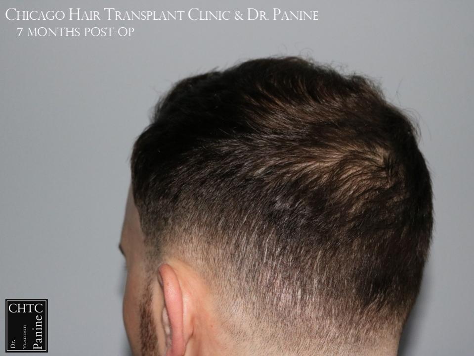 PANINE, MD FUE Hair Transplant Results