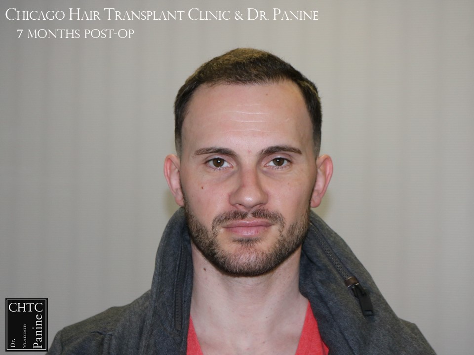 PANINE, MD FUE Hair Transplant Results