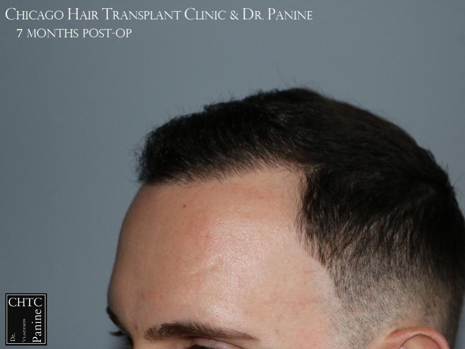 PANINE, MD FUE Hair Transplant Results