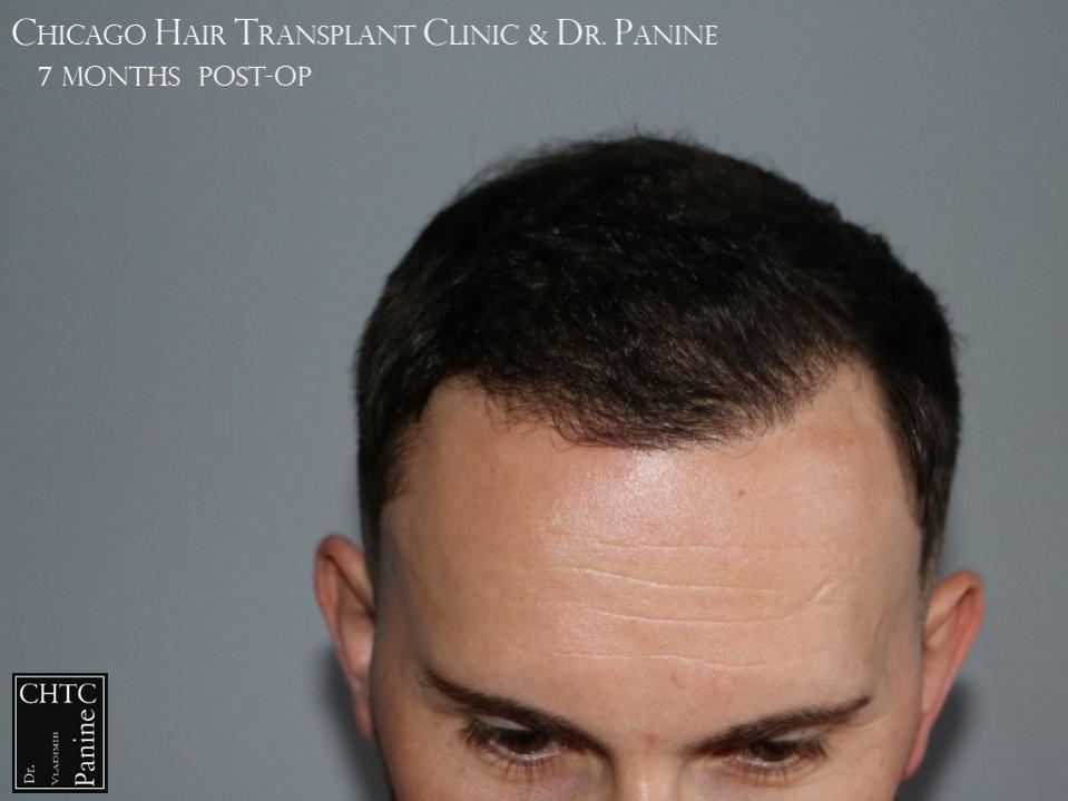 PANINE, MD FUE Hair Transplant Results