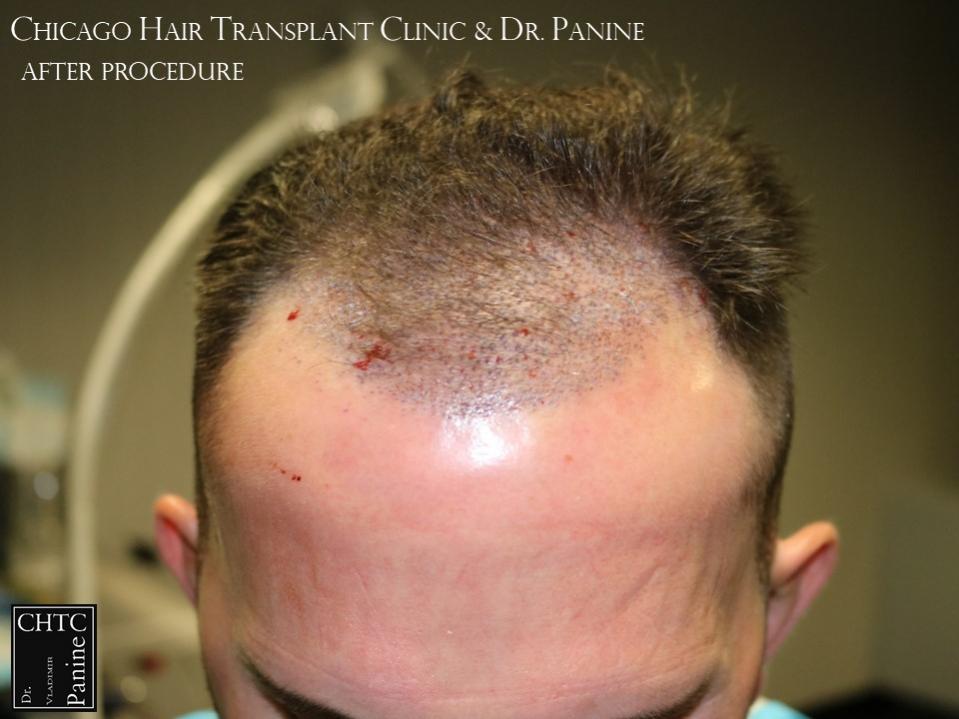 PANINE, MD FUE Hair Transplant Results