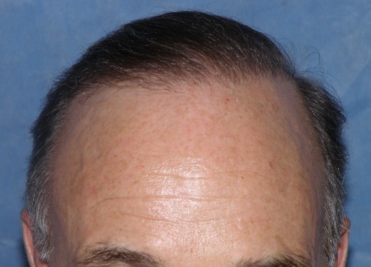 Click image for larger version

Name:	5_after-2nd-hair-transplant.jpg

Size:	49.2 KB
ID:	36203