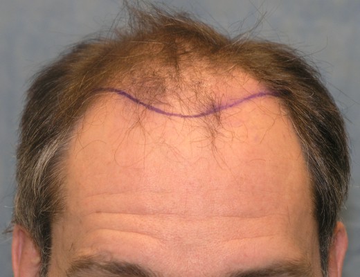 Click image for larger version

Name:	04_position-of-hairline.jpg

Size:	52.2 KB
ID:	7198