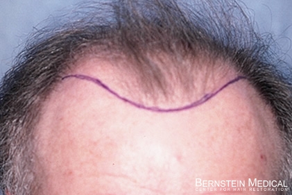 Click image for larger version

Name:	1-hairline.jpg

Size:	77.4 KB
ID:	38898