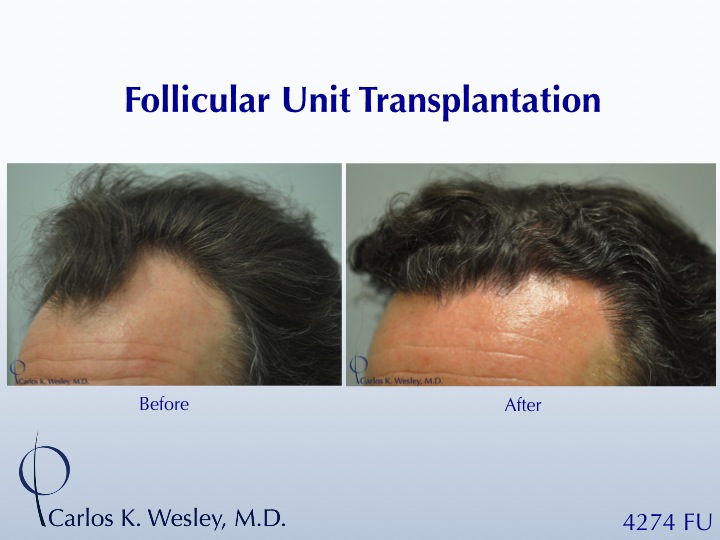 Before/After images of this 50-yr-old patient after a 4250-graft treatment by Dr. Carlos K. Wesley.  A video of his transformation may be viewed at...