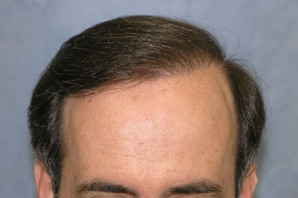 Results After 2 Sessions 
 
View his full photoset >> http://www.bernsteinmedical.com/hair-transplant-photos/portraits/patient-qpc/