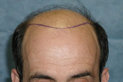 Position of new hairline before transplant 
 
View his full photoset >>...