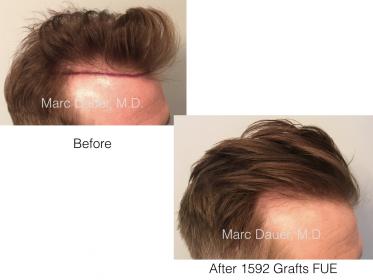 Dr. Marc Dauer hair transplant photos