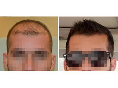 Hairs implanted 2315. See 9 months result.