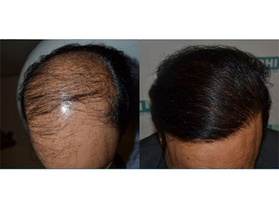 Mr Anoop Kumar 58 years old 6500 hair result