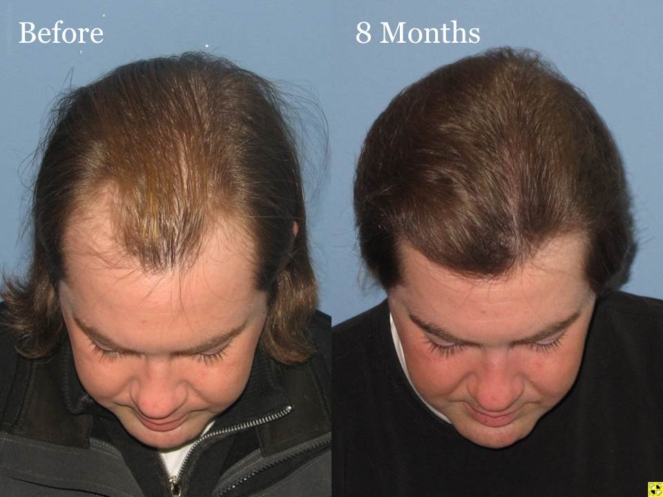 Paul Shapiro, MD 
FUT 1567 grafts 
8 months post-op