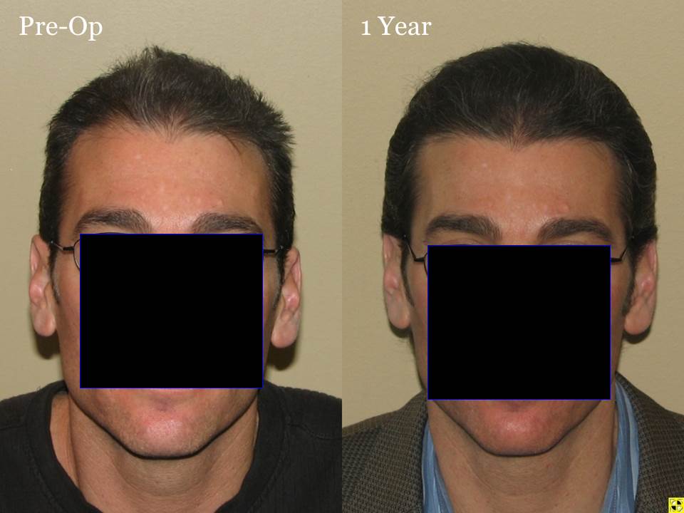 Paul Shapiro, MD 
FUT 2619 grafts 
12 months post-op