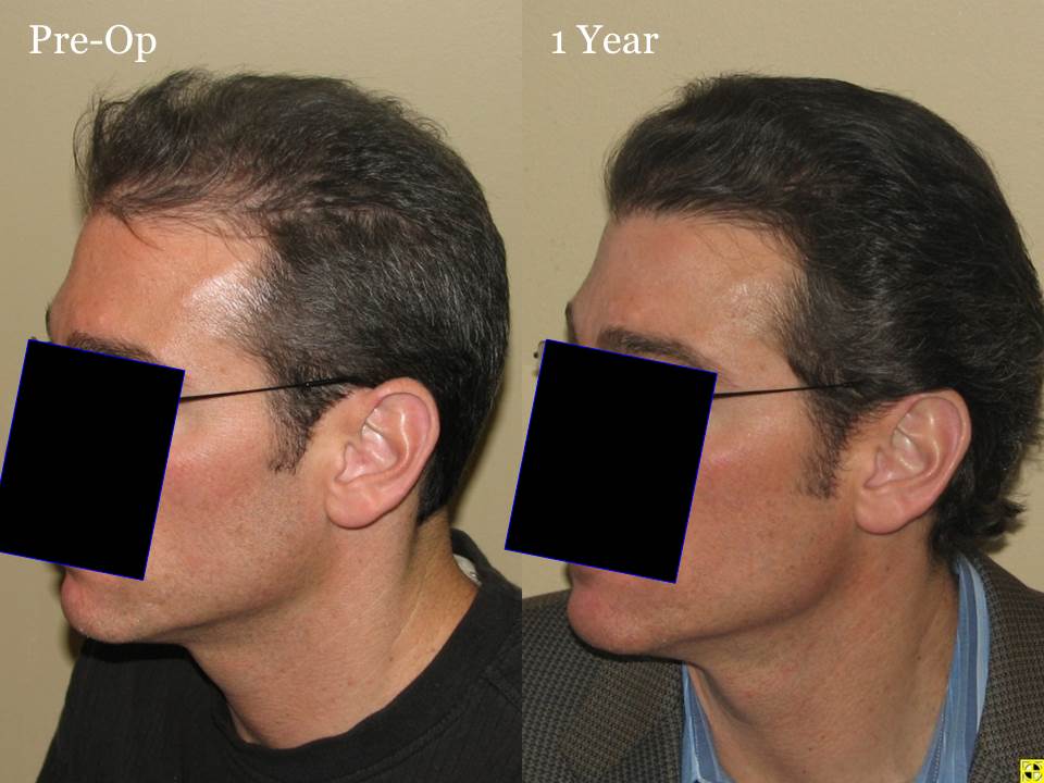 Paul Shapiro, MD 
FUT 2619 grafts 
12 months post-op