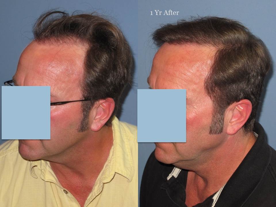 Dr. Paul Shapiro, MD 
FUT 2103 grafts 
 12 months post op