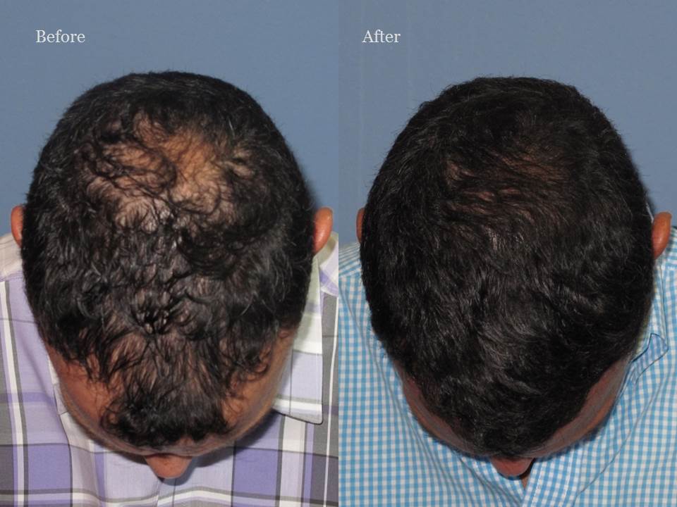 Dr. Paul Shapiro, MD 
FUT 3085 grafts 
12 months post op