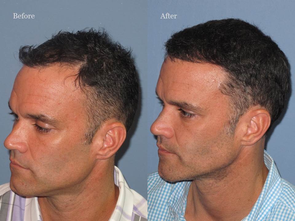 Dr. Paul Shapiro, MD 
FUT 3085 grafts 
12 months post op