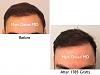 Click image for larger version

Name:	Hair Transplant Slides copy5.001.jpg

Size:	10.9 KB
ID:	43274