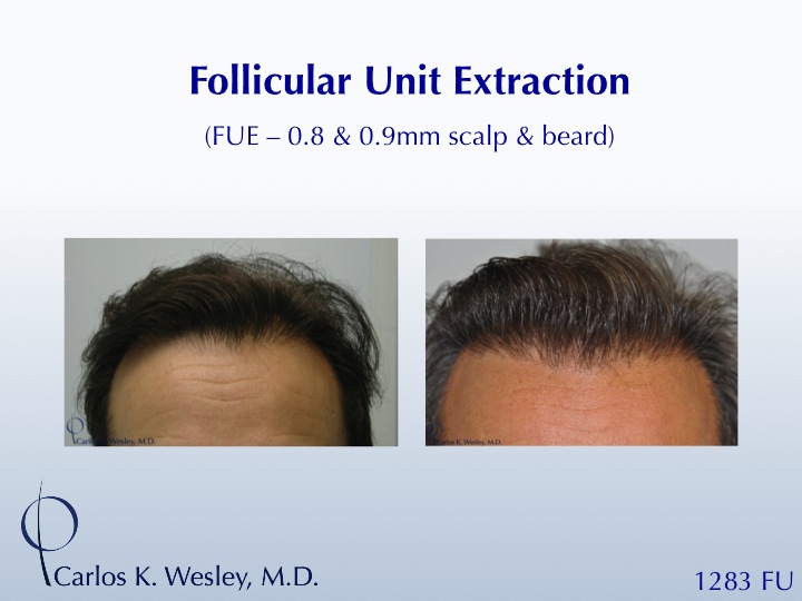 This patient had 1283 FUE grafts from beard and scalp with Dr. Carlos K. Wesley in NYC.   
 
An interactive before/after image can be viewed here:...