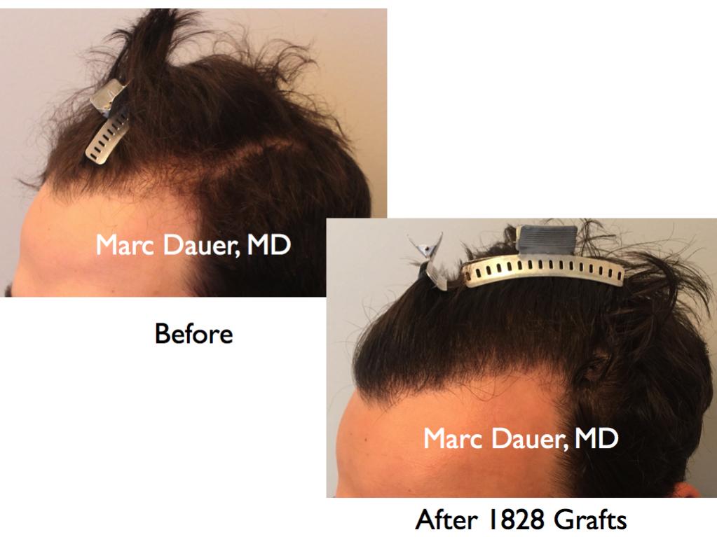 Click image for larger version

Name:	Hair Transplant Slides.606.jpg

Size:	61.9 KB
ID:	39432