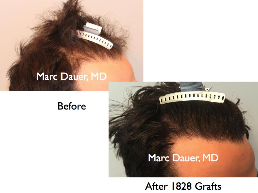 Click image for larger version

Name:	Hair Transplant Slides.607.jpg

Size:	62.9 KB
ID:	39433