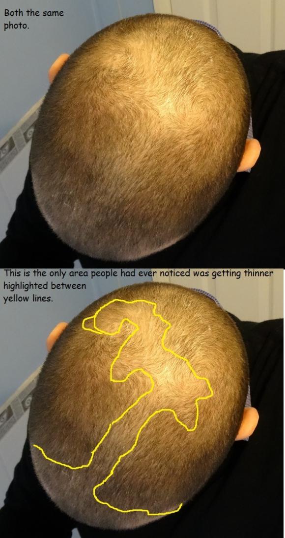 Click image for larger version

Name:	6 Current Hair Loss #1.jpg

Size:	84.7 KB
ID:	36894